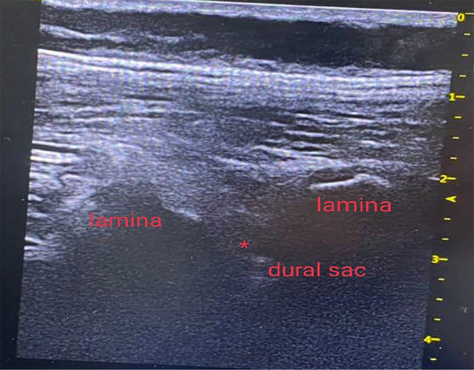 Ultrasound guided quadratus lumborum block versus interlaminar epidural block for analgesia in pediatric abdominal surgery: a randomized controlled trial