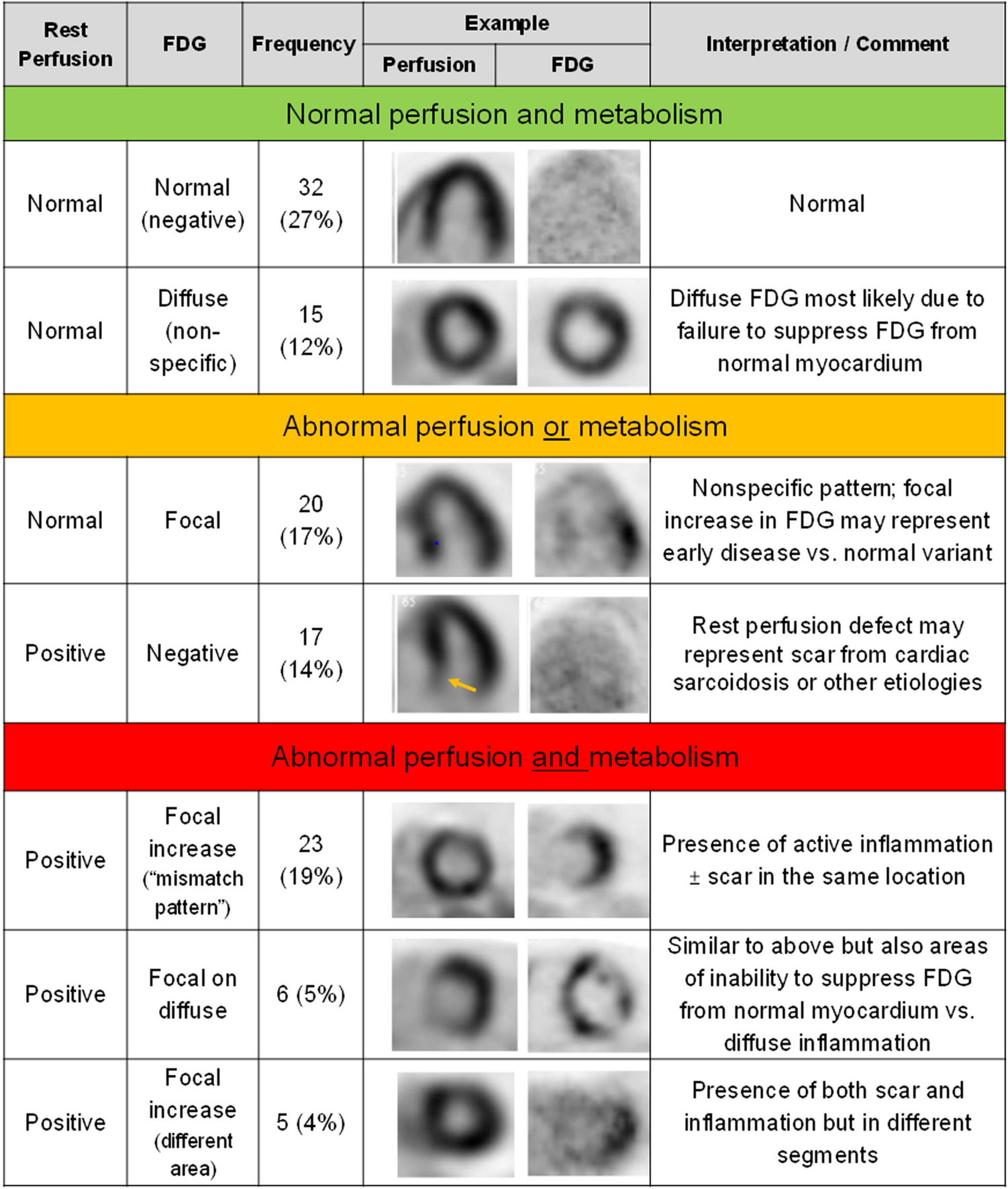 Inflammation and Myocardial Blood Flow in Cardiac Sarcoidosis