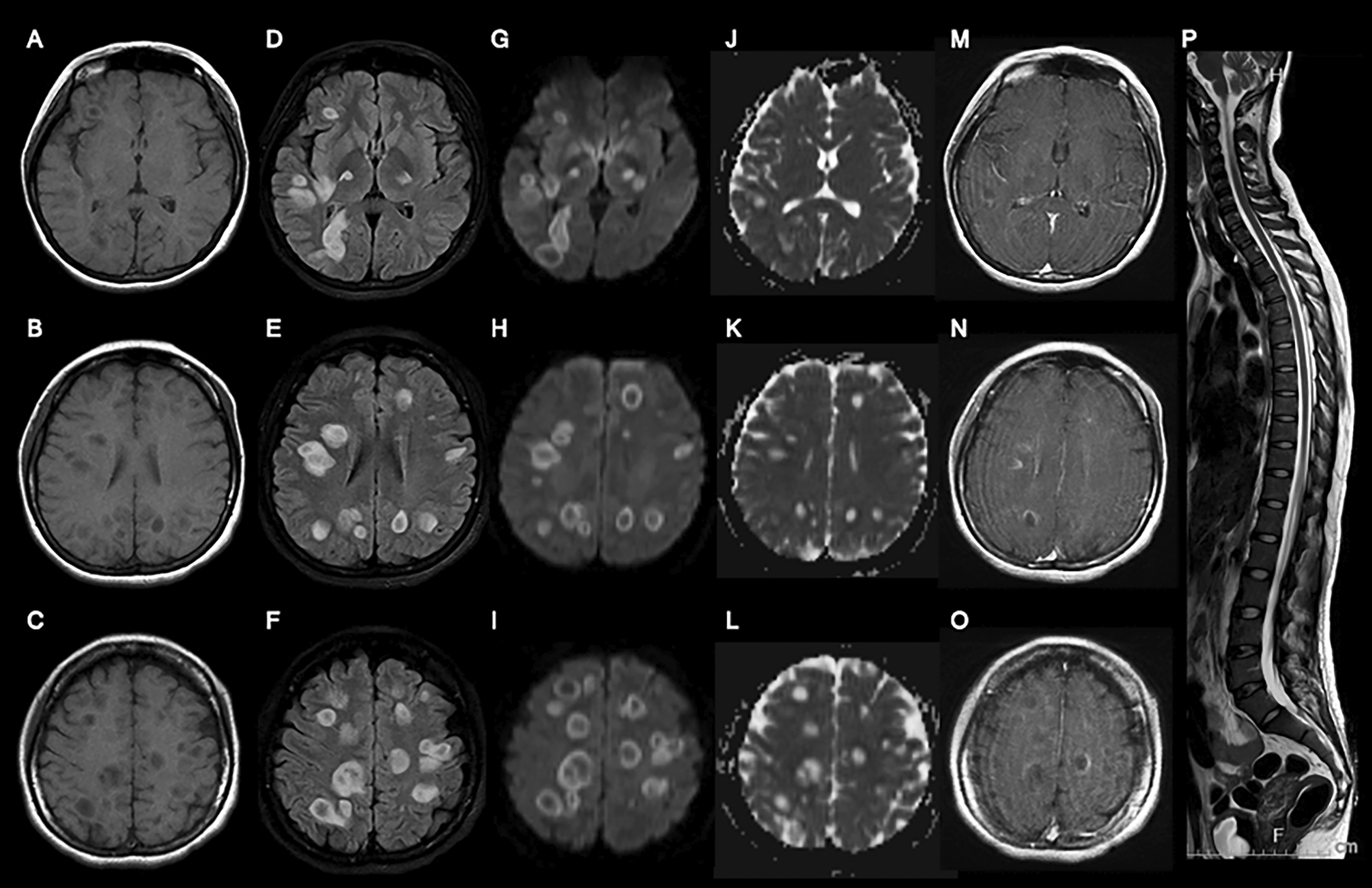 Catastrophic tumefactive acute disseminated encephalomyelitis in patient with dengue virus: a case report