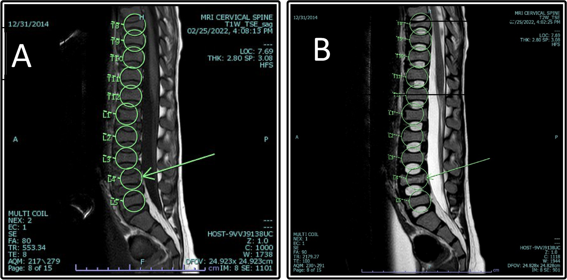 Vertebral compression fracture as the only presentation sign of acute lymphoblastic leukemia: a case report