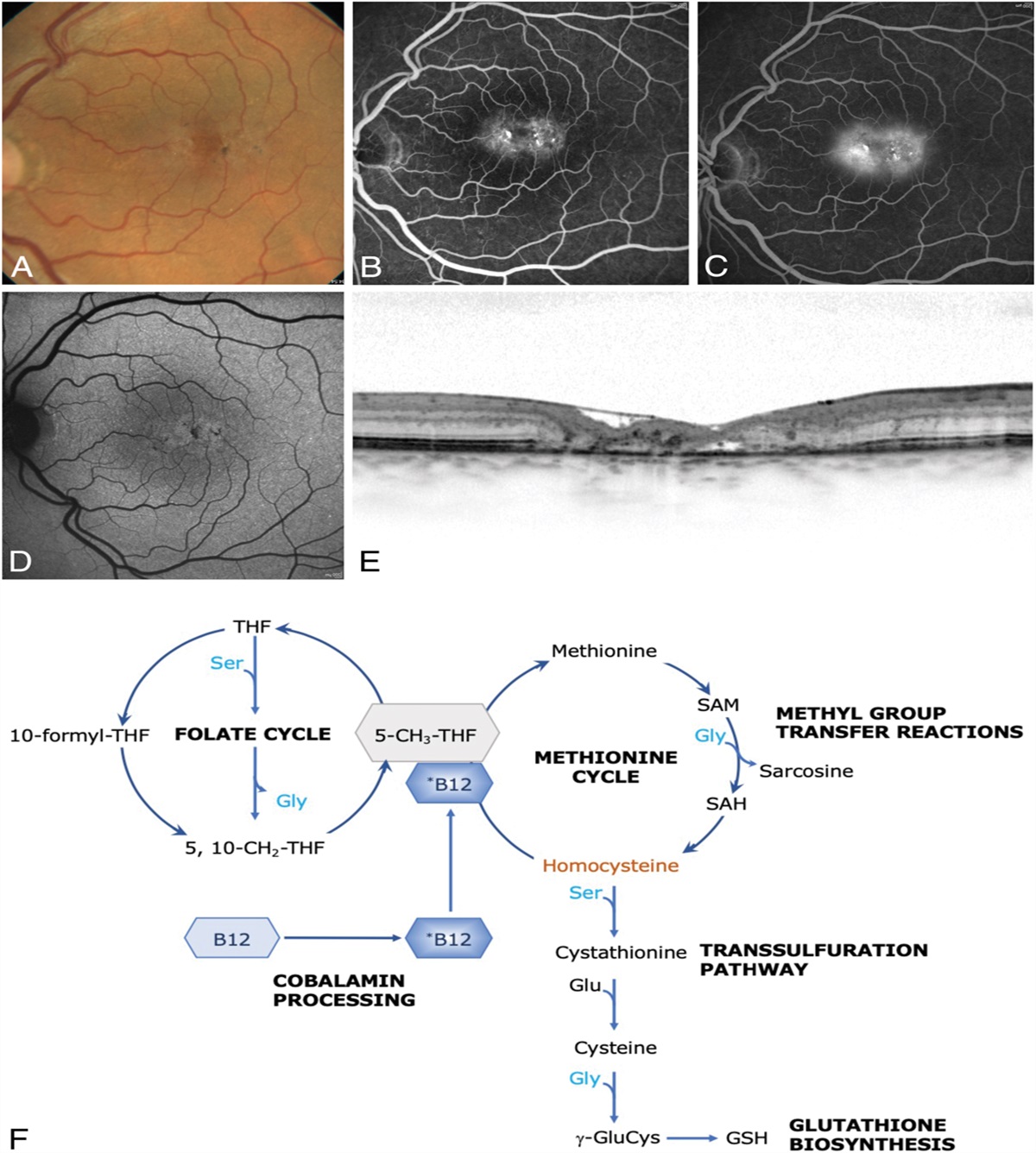 METHYLATION-ASSOCIATED PATHWAYS IN MACULAR TELANGIECTASIA TYPE 2 AND OPHTHALMOLOGIC FINDINGS IN PATIENTS WITH GENETIC METHYLATION DISORDERS