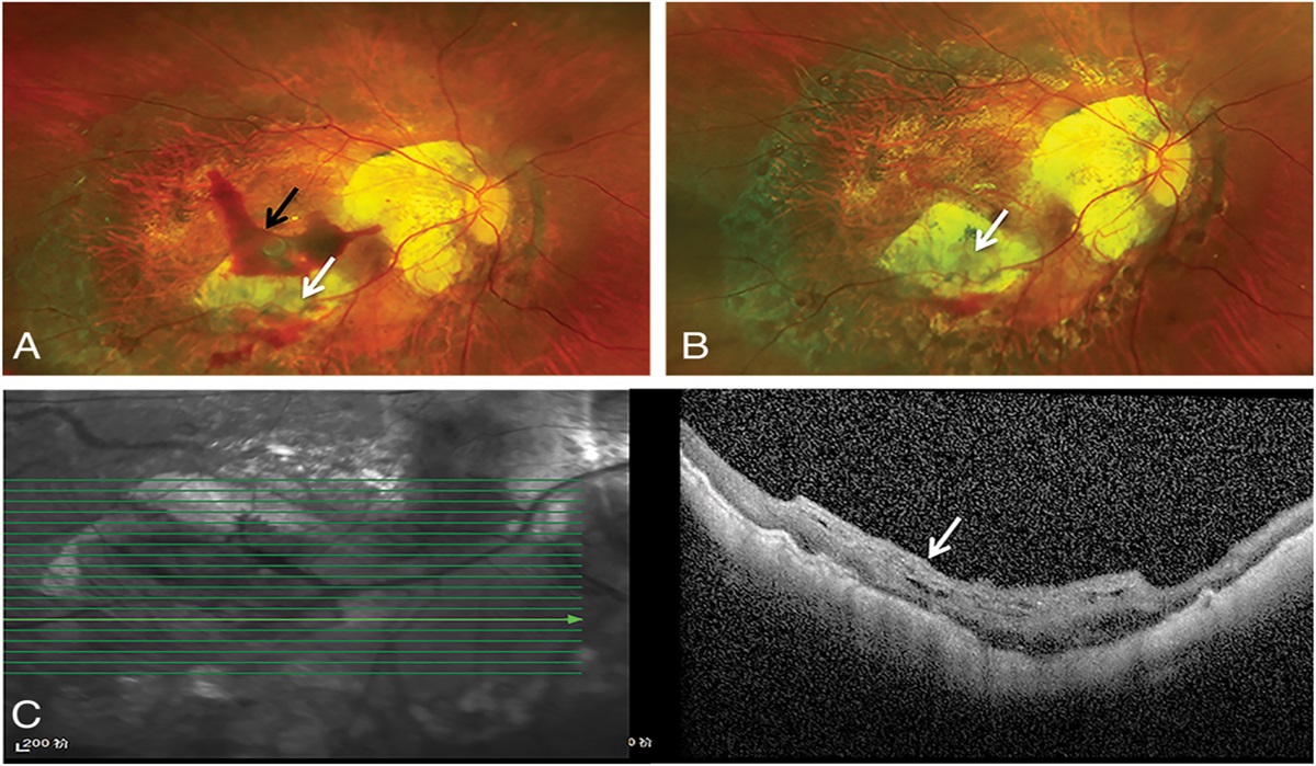 PRETREATED LYOPHILIZED HUMAN AMNIOTIC MEMBRANE GRAFT COVERING FOR RETINAL DETACHMENT WITH POSTERIOR RETINAL BREAKS ABOVE CHORIORETINAL ATROPHY IN PATHOLOGIC MYOPIA