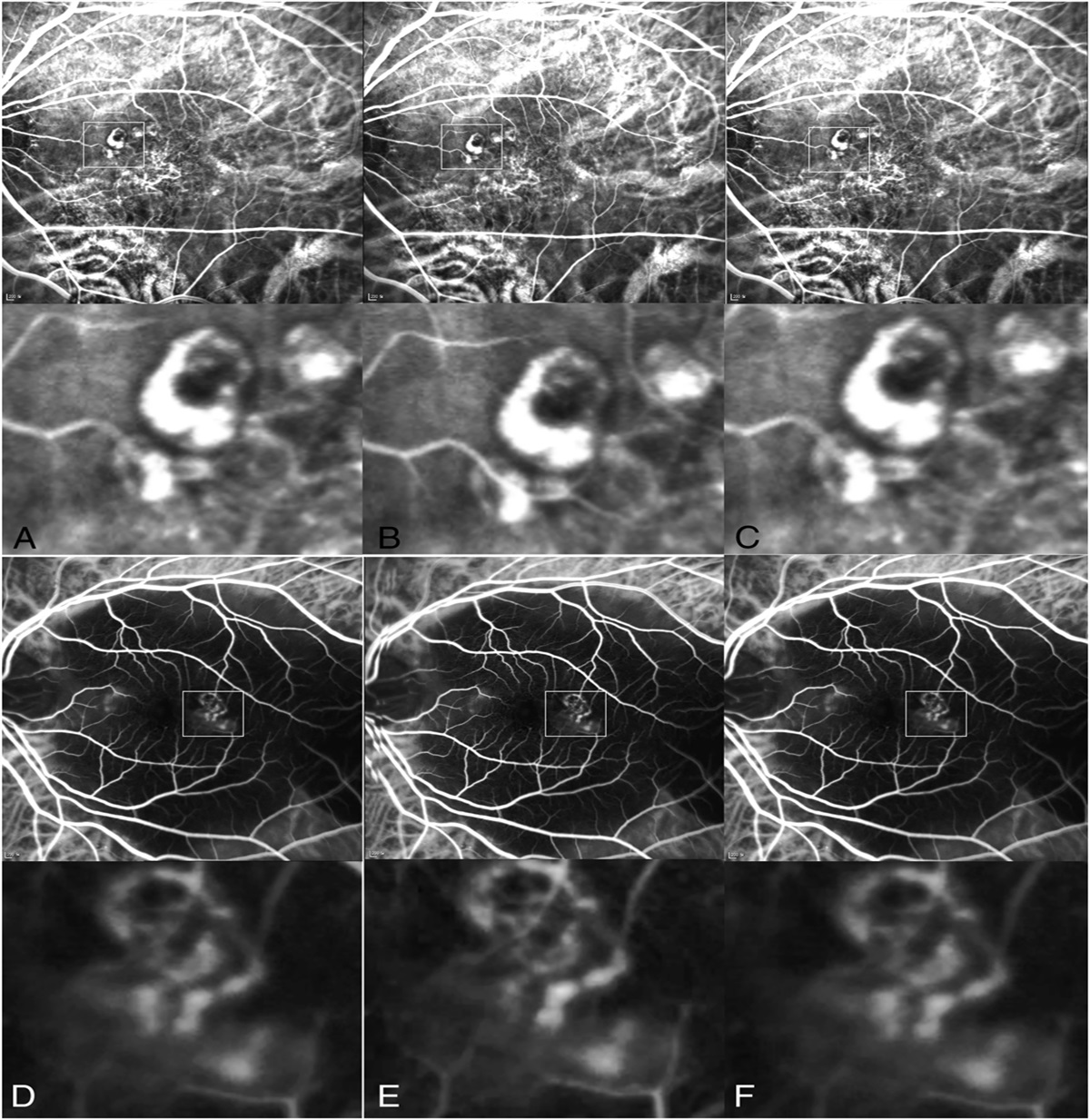 IMAGING AND CLINICAL FEATURES OF PULSATILE POLYPOIDAL CHOROIDAL VASCULOPATHY