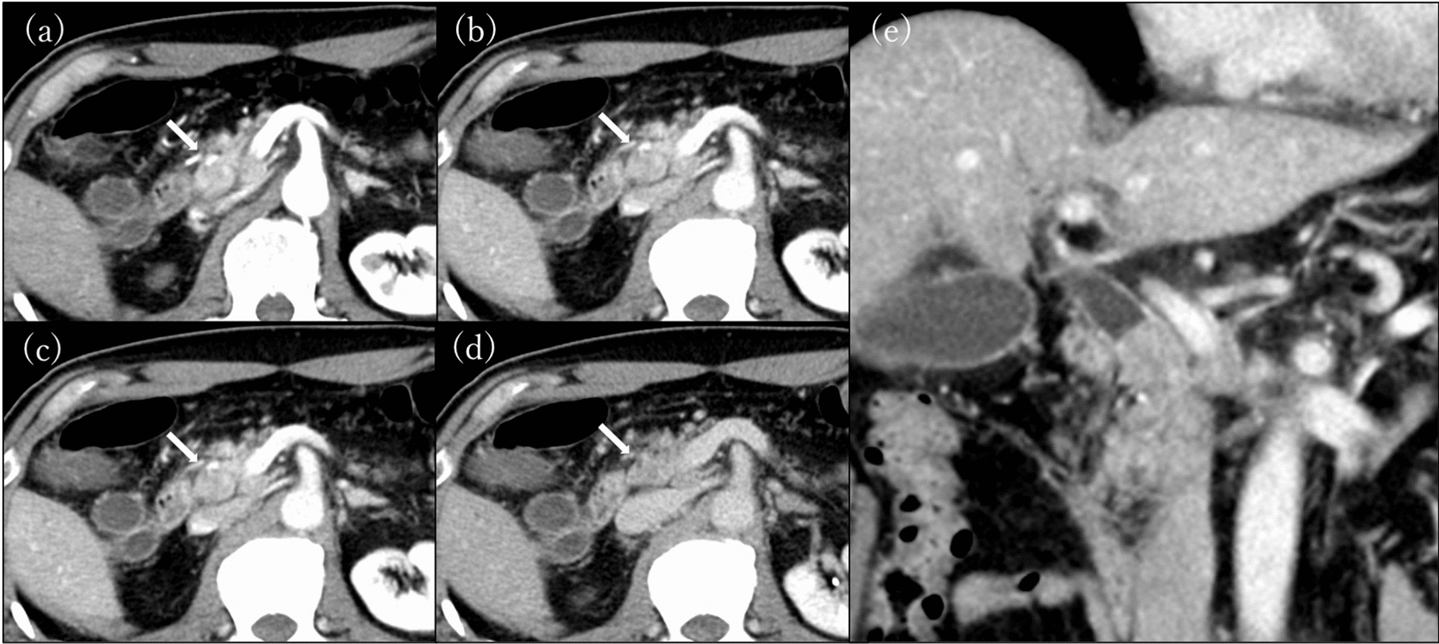 Mixed neuroendocrine–non-neuroendocrine neoplasm of the bile duct with long-term prognosis after neoadjuvant chemotherapy