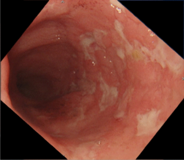 A case of cytomegalovirus esophagitis difficult to distinguish from Crohn’s disease exacerbation