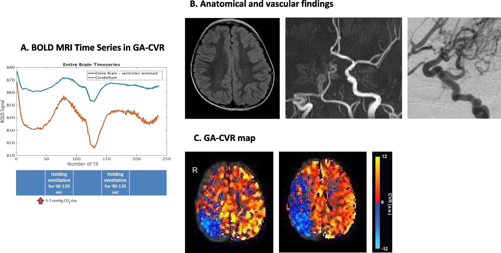 Assessment of MR blood-oxygen-level-dependent (BOLD) cerebrovascular reactivity under general anesthesia in children with moyamoya
