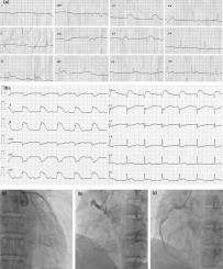 Abnormal ST-segment changes in anterior and inferior leads during acute inferior myocardial infarction