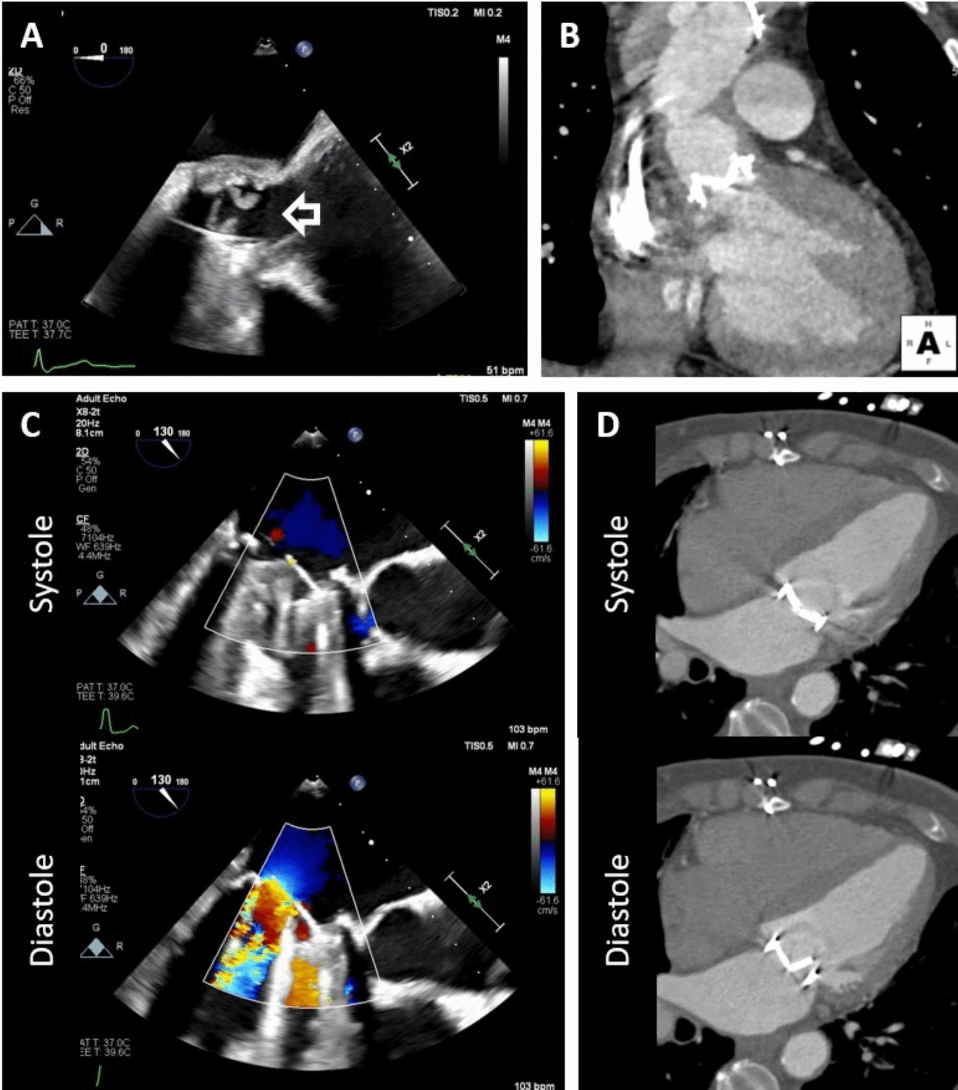 Evaluation and Management of Mechanical Heart Valve Dysfunction and Thrombosis