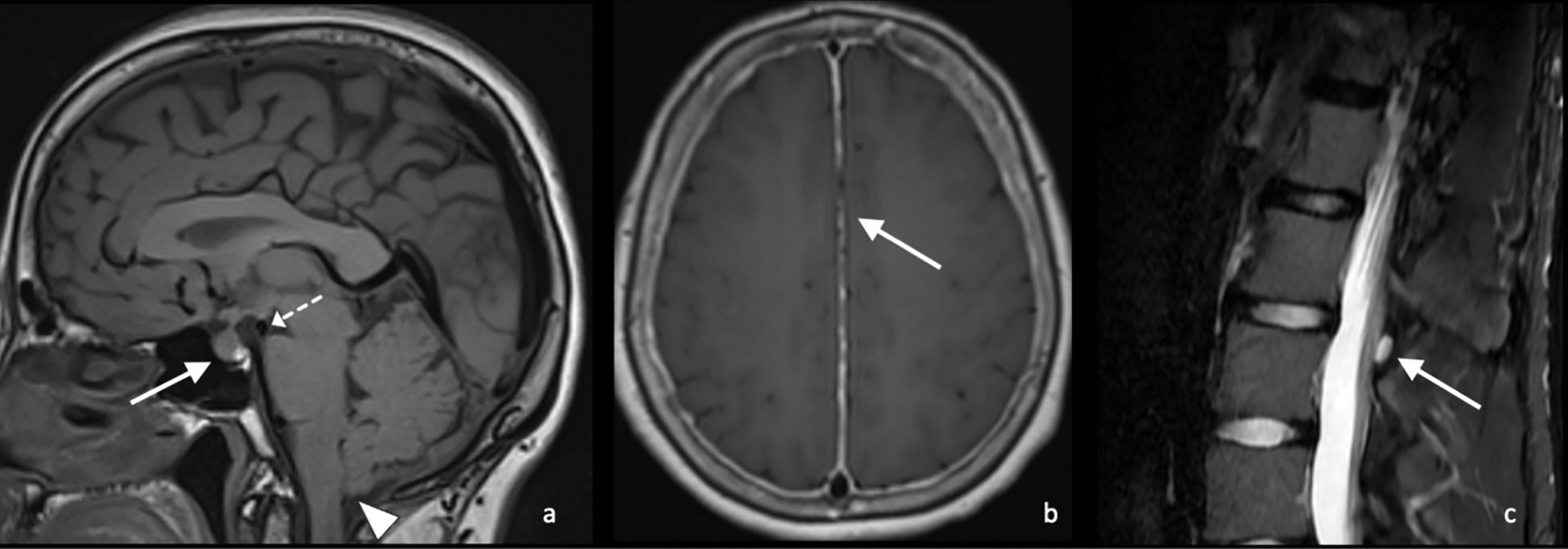 Lumbar Puncture Complications: A Review of Current Literature