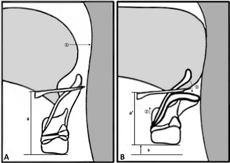 Sleep apnea patients with epiglottic collapse elevate their larynx more with swallowing; videofluoroscopic swallowing study of 80 patients