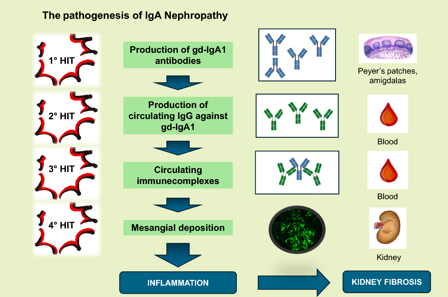 Drugs in Development to Treat IgA Nephropathy