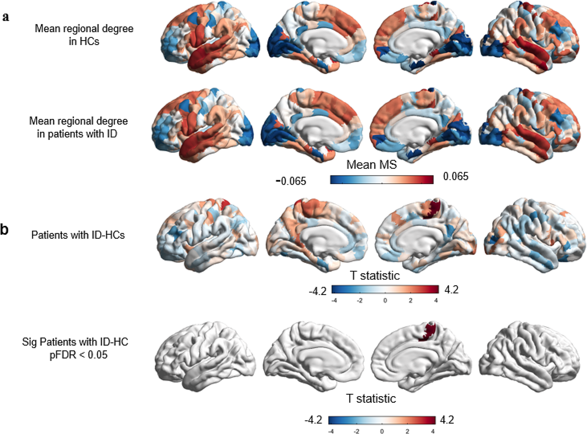 Altered morphometric similarity networks in insomnia disorder
