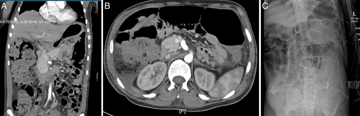 Clozapine-Related Functional Bowel Obstruction: A Rare Adverse Effect Unmasking Quetiapine and Benztropine Interaction Raising Need for Bowel Surveillance