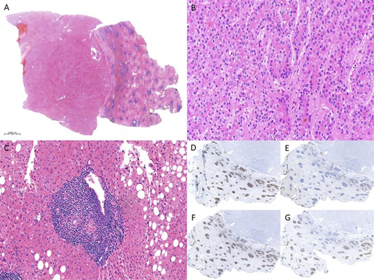 Hepatocellular Carcinoma With Chronic Lymphocytic Leukemia/Small Lymphocytic Lymphoma in the Absence of Cirrhosis