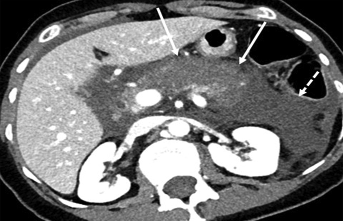 A Rare Case of Sigmoid Colon Perforation in a Patient With Severe Acute Pancreatitis