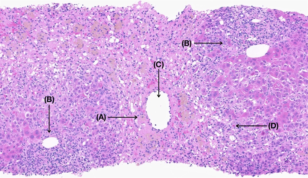 Severe Drug-Induced Liver Injury Due to Self-administration of the Veterinary Anthelmintic Medication, Fenbendazole