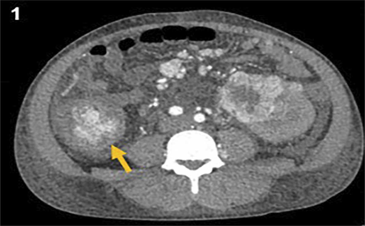 Cecal Metastasis of Clear Cell Renal Cell Carcinoma After Previous Nephrectomy