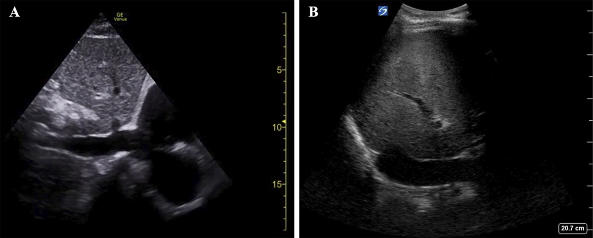 Congestive Hepatopathy Diagnosed by Venous Excess Ultrasound Score