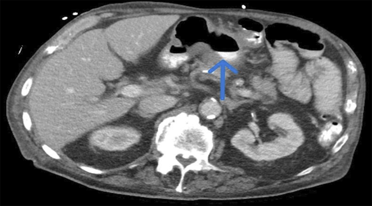 Benign Peptic Ulcer as a Cause of Gastrocolic Fistula