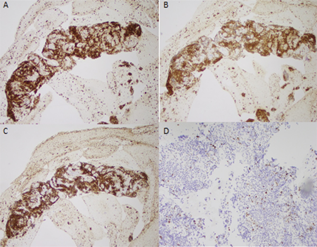 An Endoscopic Ultrasound Diagnosis of a Rare Cause of Pancreatic Body Mass Demonstrating the Transformation to Large B-Cell Lymphoma