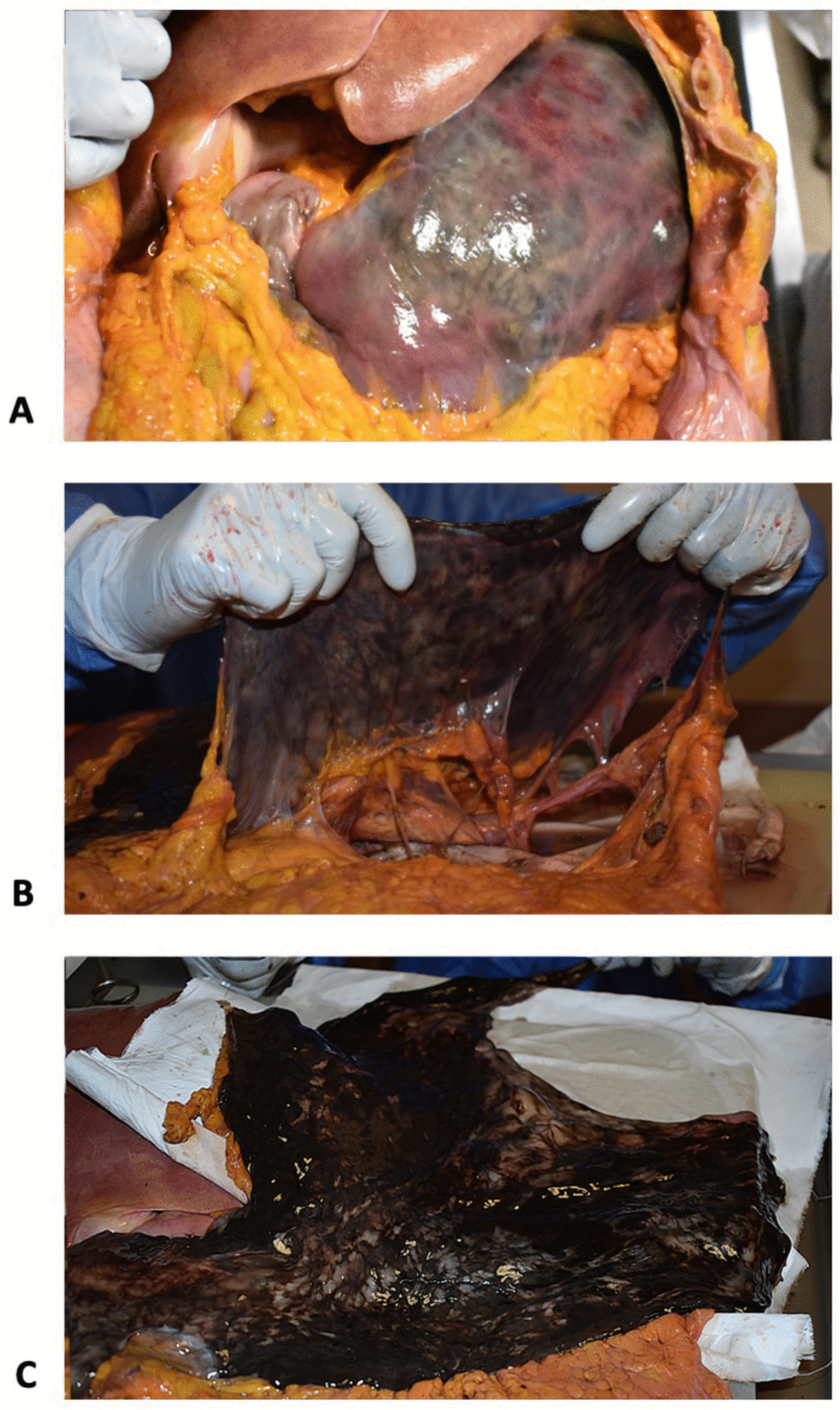 Gastric ischemia as an under-reported cause of death in older people