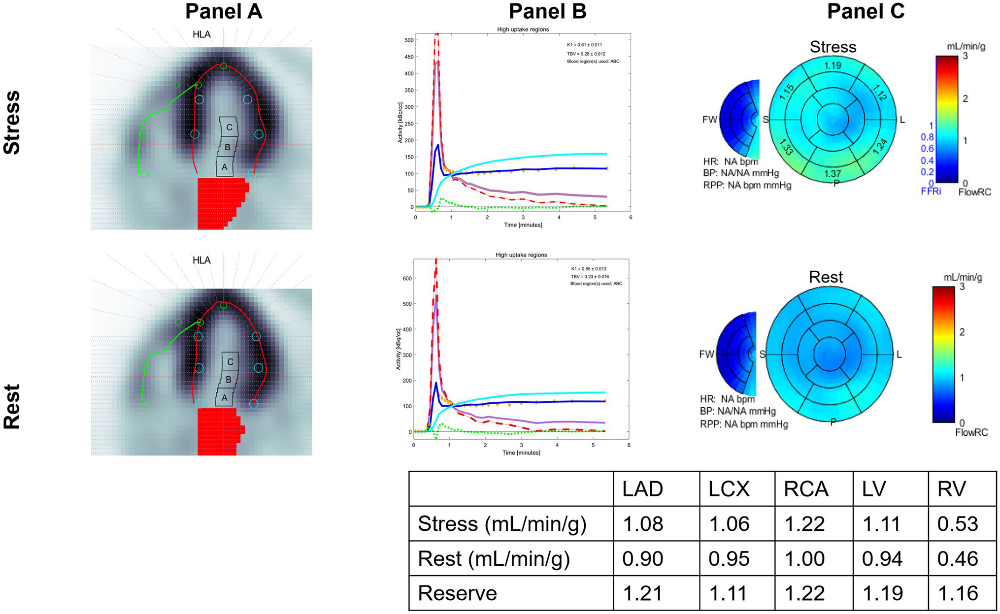 Links Between Obstructive Sleep Apnea and Myocardial Blood Flow Changes Impacting Adverse Cardiovascular Disease-related Outcomes