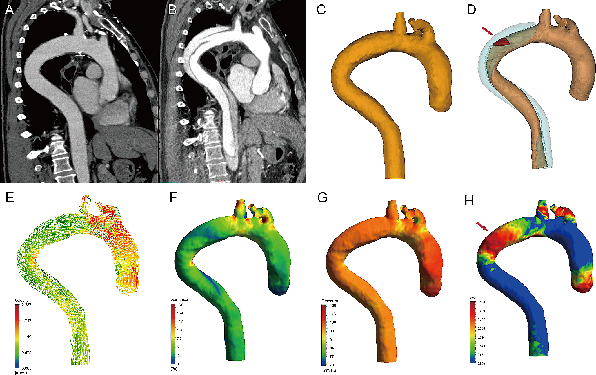 Computational fluid dynamic before aortic dissection