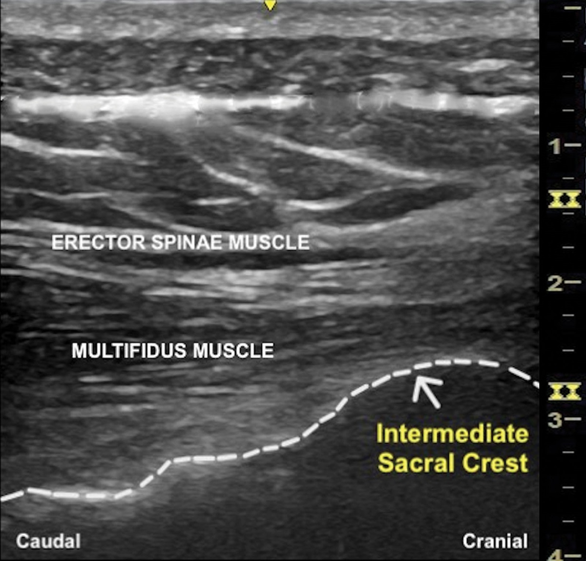 Ultrasound-Guided Sacral Erector Spinae Plane Block: A Feasible Option for Pain Management During Magnetic Resonance Imaging: A Case Report