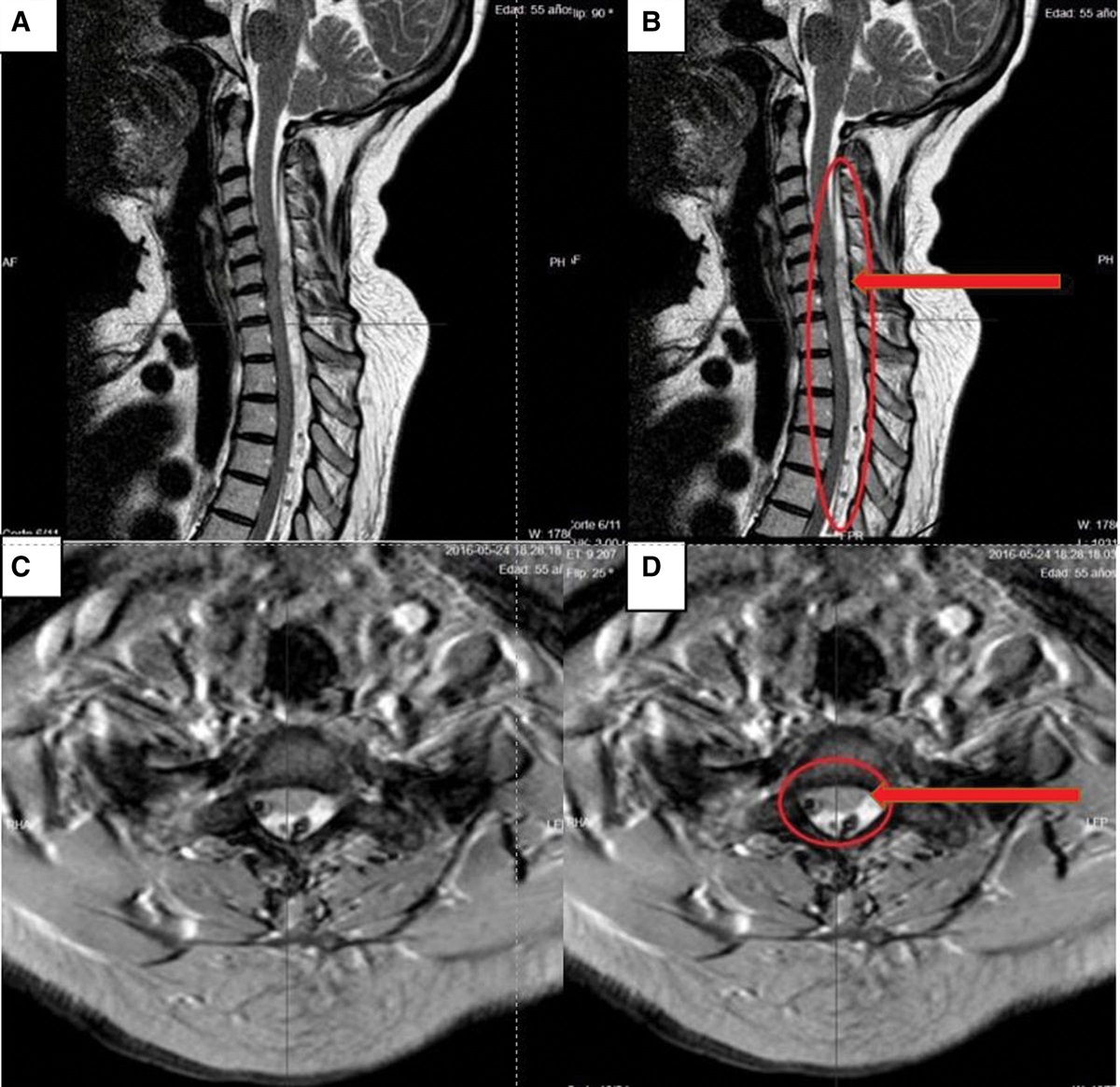 Epidural Hematoma Associated with Red Clover Use After Epidural Injection: A Case Report