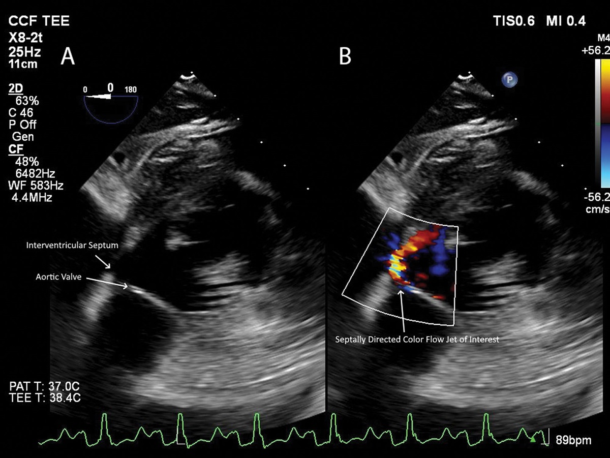Abnormal Color Flow Jet in Left Ventricular Outflow Tract Mimicking a Ventricular Septal Defect: Establishing Differentials and Diagnosis and Role of Transesophageal Echocardiography