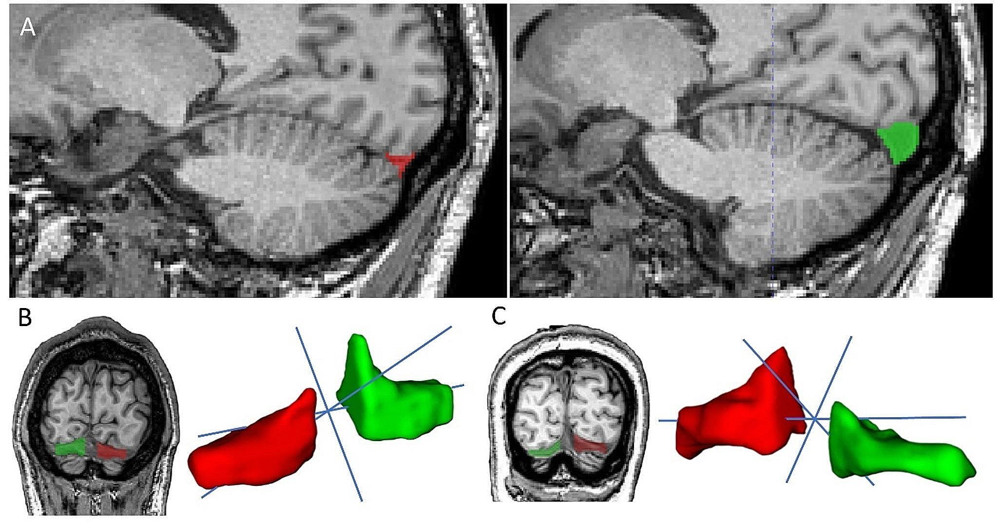 Brain (Yakovlevian) torque direction is associated with volume asymmetry of the intracranial transverse sinuses: evidence from situs inversus totalis