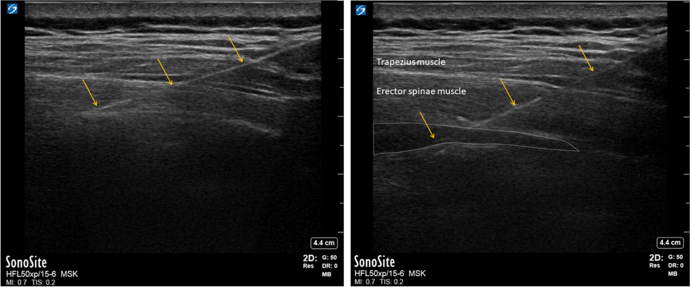 Evaluation of the Erector spinae plane block for postoperative analgesia in laparoscopic ventral hernia repair: a randomized placebo controlled trial