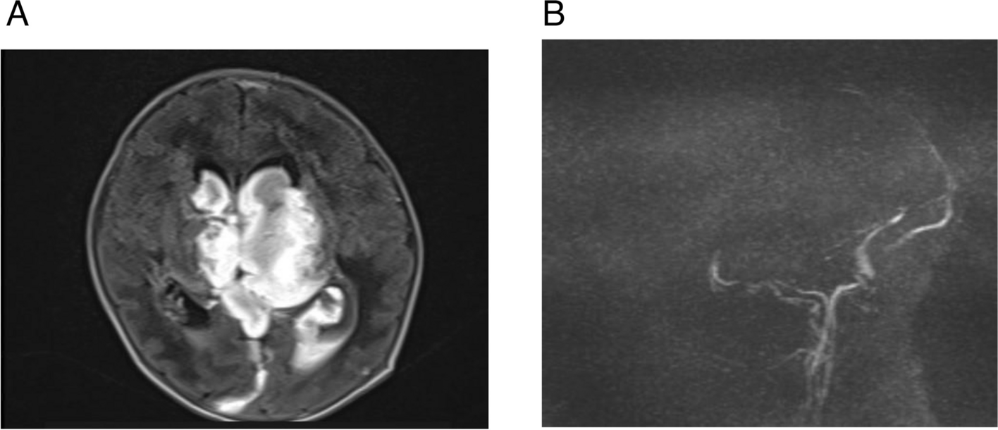 Recurrent hyponatremia in neonate: a case of renal salt wasting syndrome