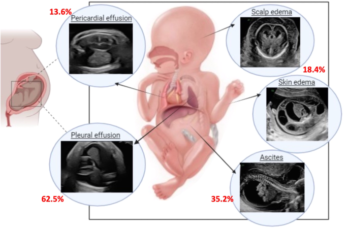 Hydrops and congenital diaphragmatic hernia: reported incidence and postnatal outcomes. Analysis of the congenital diaphragmatic hernia study group registry
