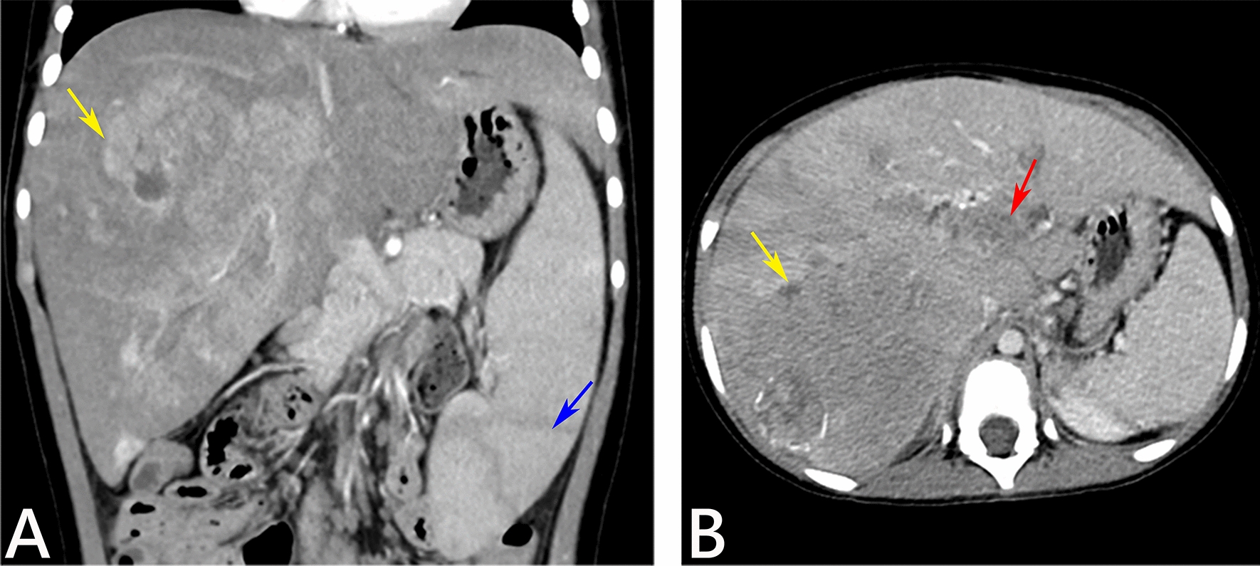 A rare case report: multiple intrahepatic masses in a pediatric patient with citrin deficiency