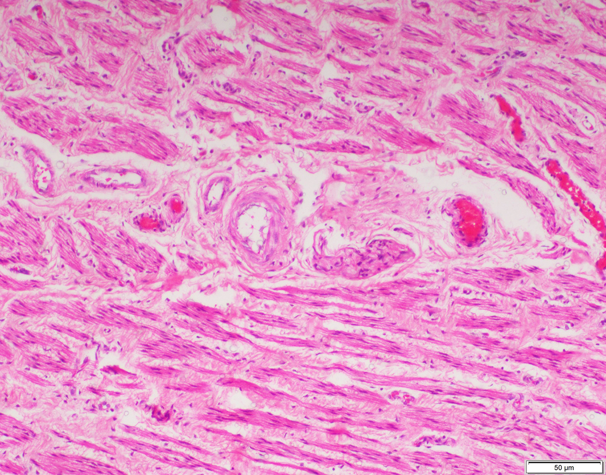 A comparative study of smooth muscle cell characteristics and myofibroblasts in processus vaginalis of pediatric inguinal hernia, hydrocele and undescended testis