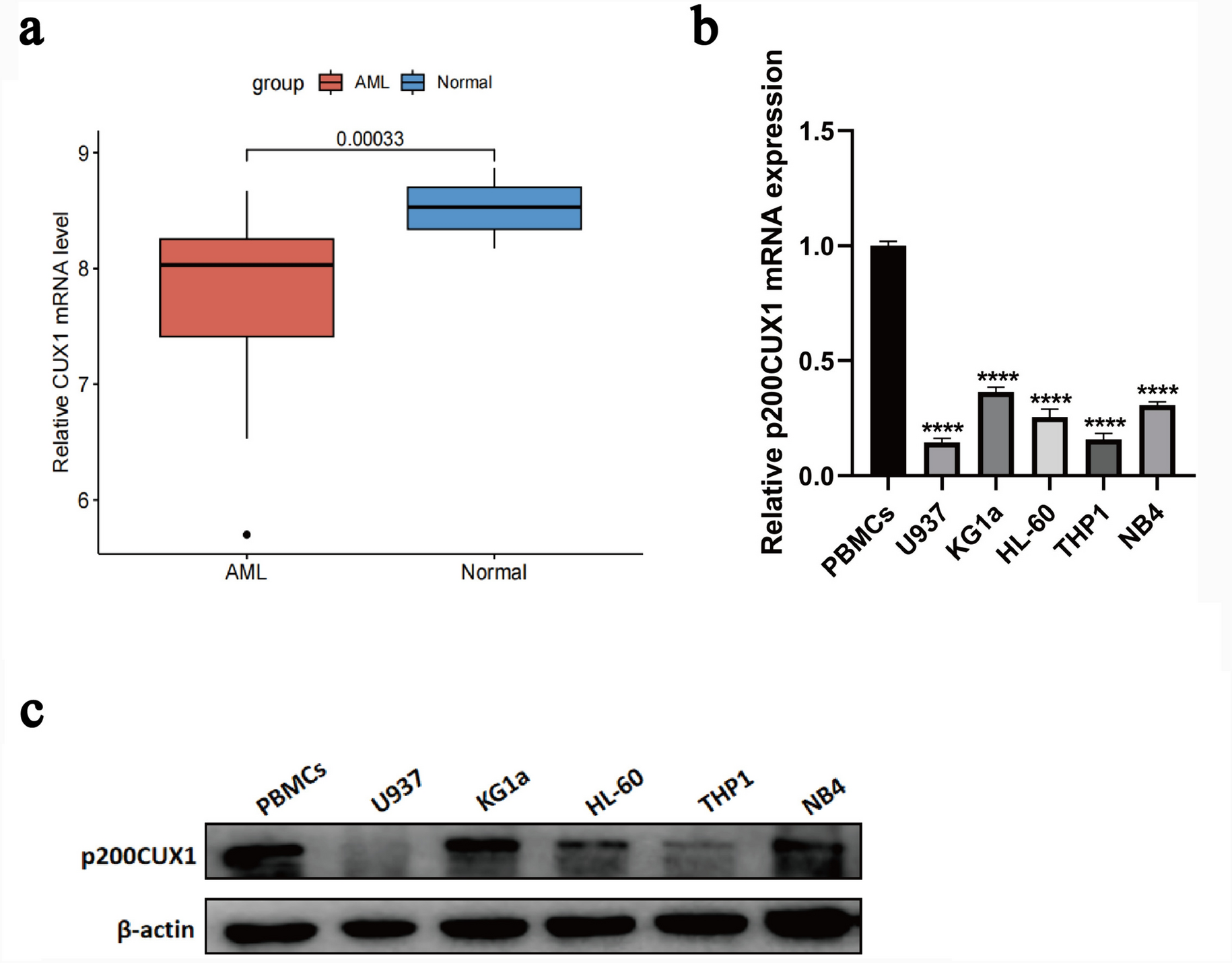 p200CUX1-regulated BMP8B inhibits the progression of acute myeloid leukemia via the MAPK signaling pathway