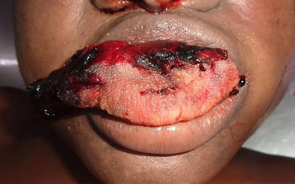 Partial amputation due to tongue bite in death-associated with eclampsia