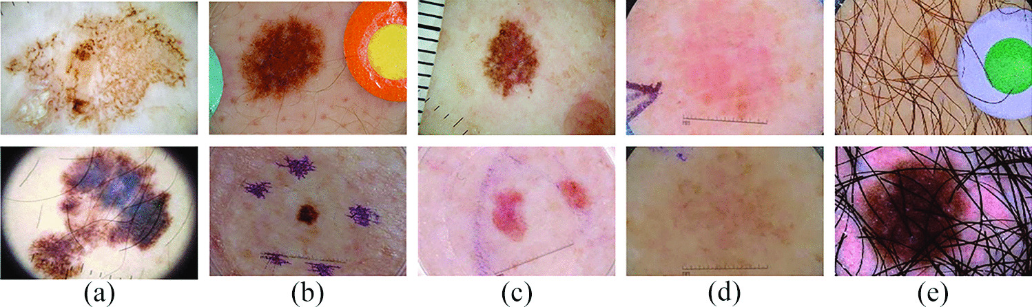 RA-Net: Region-Aware Attention Network for Skin Lesion Segmentation