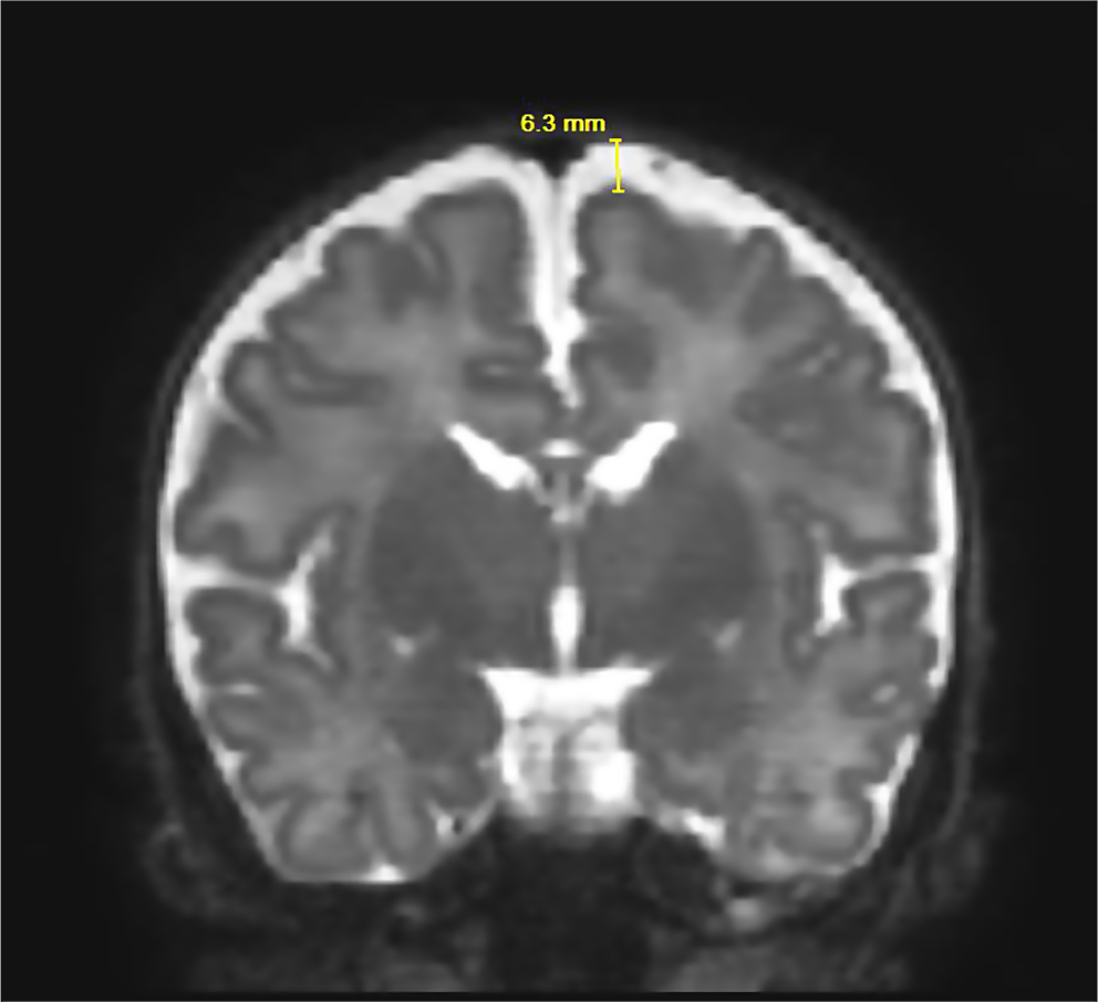 Association of enlarged extra-axial spaces and subdural hemorrhage in preterm infants at term-equivalent age