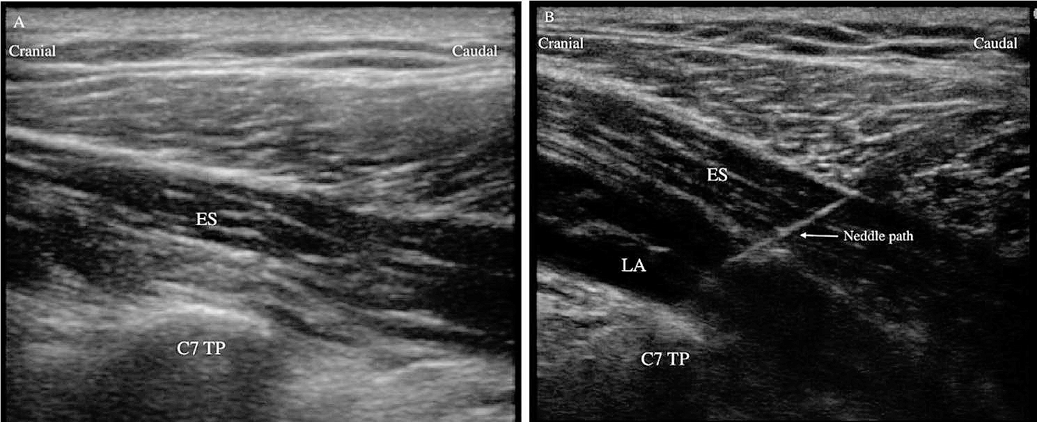 The analgesic effect of ultrasound-guided cervical erector spinae block in arthroscopic shoulder surgery: a randomized controlled clinical trial