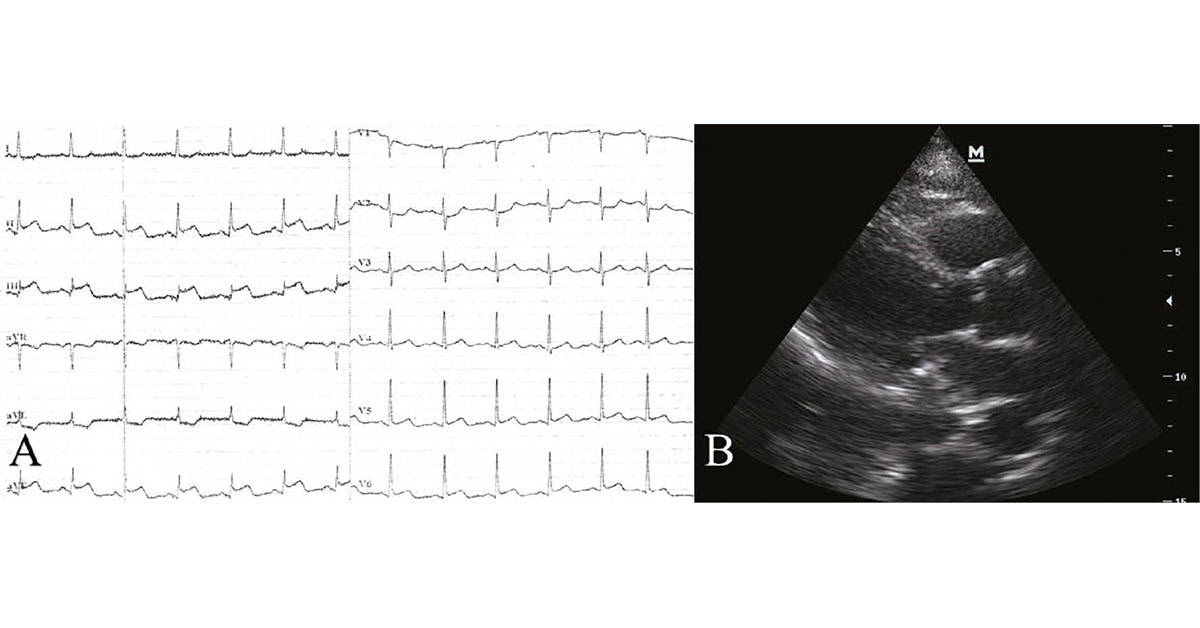 Immediate Interventional Management of Aortocoronary Dissection During PCI