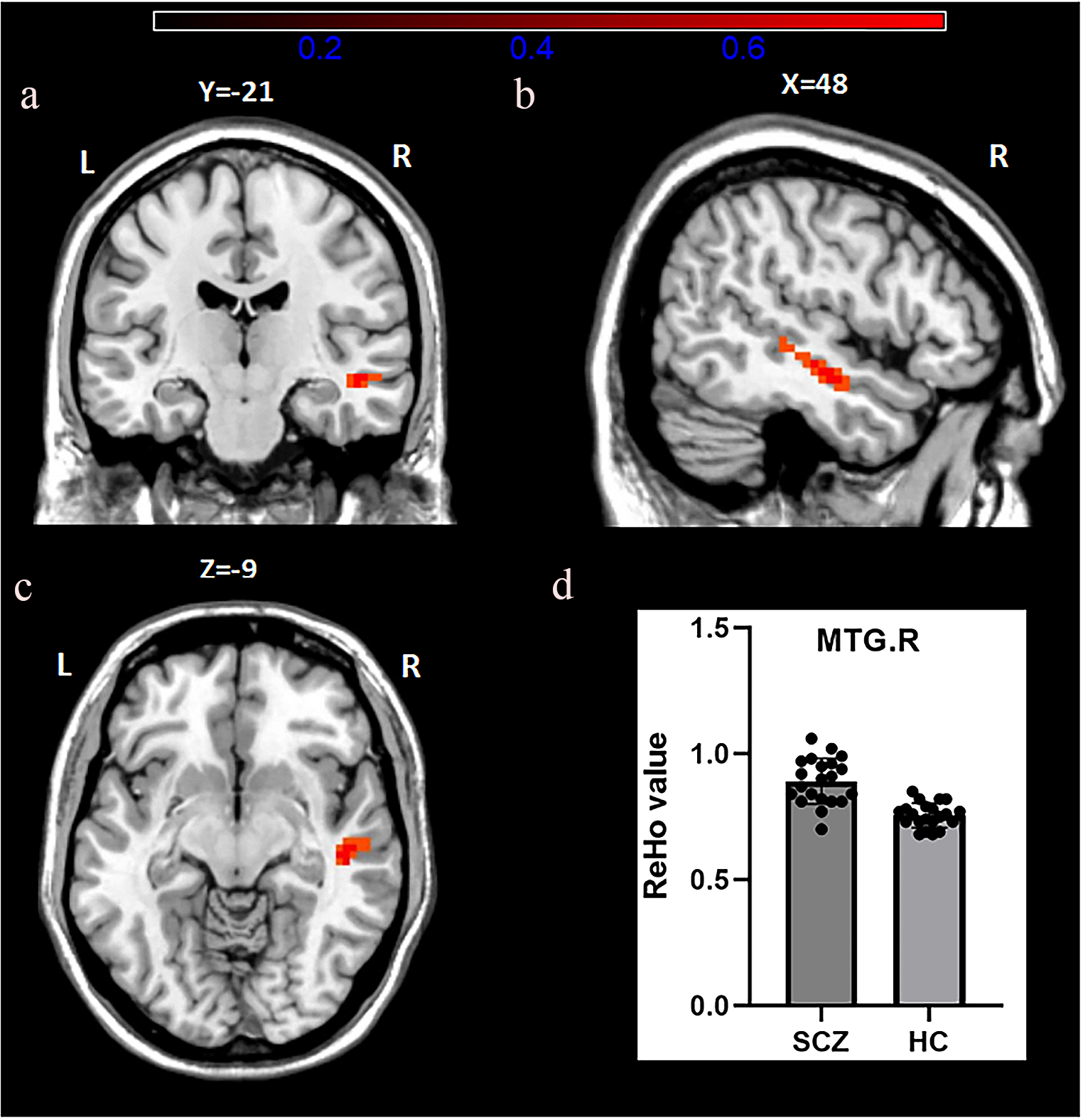 Altered temporal lobe connectivity is associated with psychotic symptoms in drug–naïve adolescent patients with first–episode schizophrenia