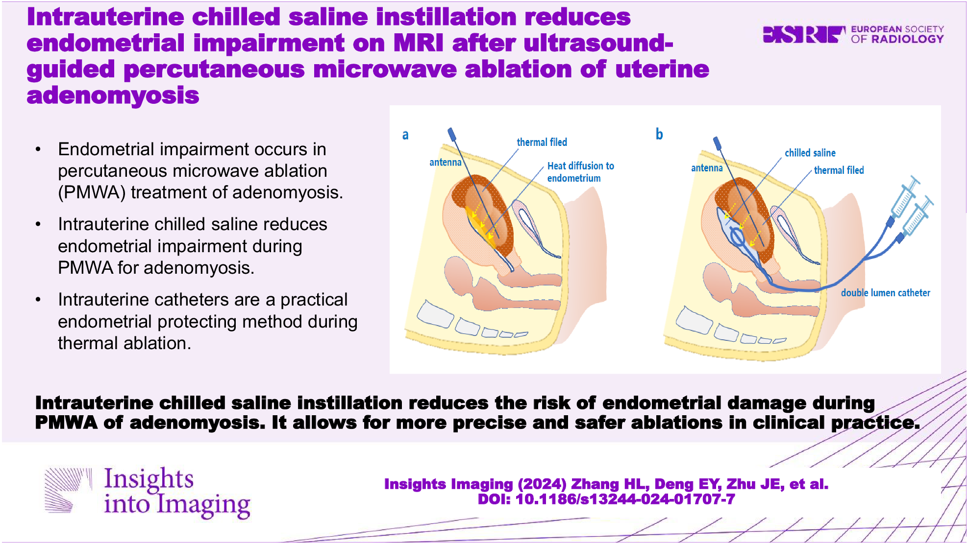 Intrauterine chilled saline instillation reduces endometrial impairment on MRI after ultrasound-guided percutaneous microwave ablation of uterine adenomyosis