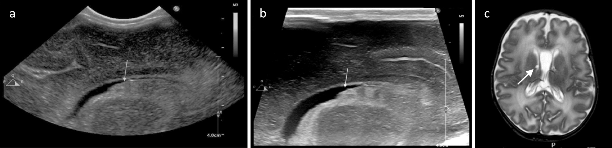 Cranial ultrasound in preterm infants ≤ 32 weeks gestation—novel insights from the use of very high-frequency (18-5 MHz) transducers: a case series