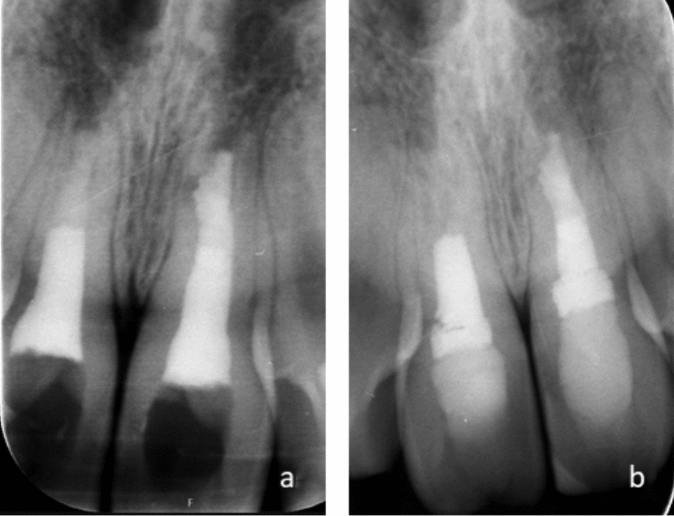 Prognosis of non-vital incisors after apexification using bioceramics: a retrospective study