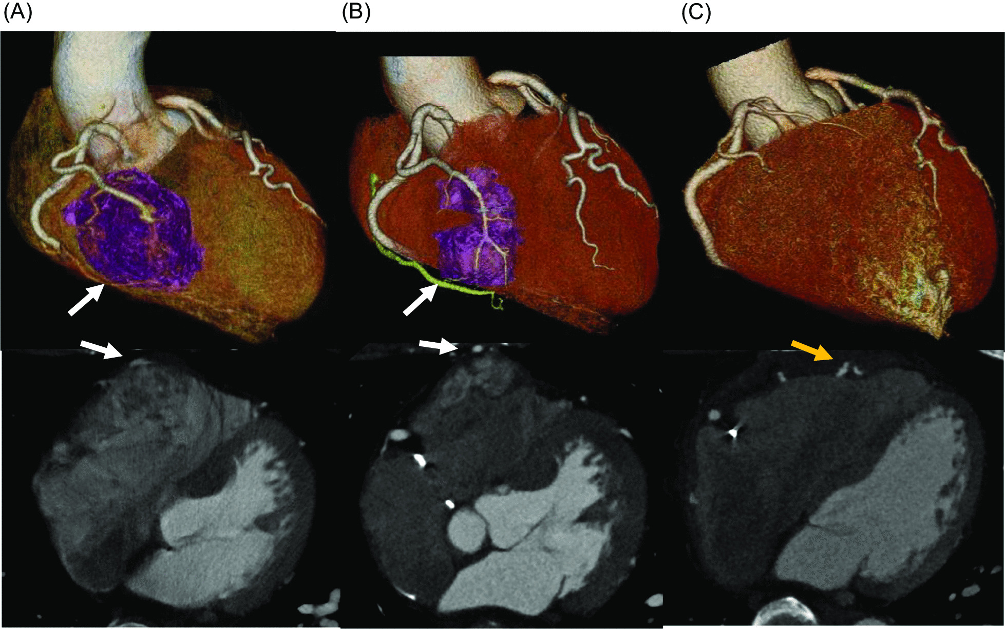 A case of surgical treatment for recurrence of right ventricular metastasis due to renal cell carcinoma after molecular targeted therapy