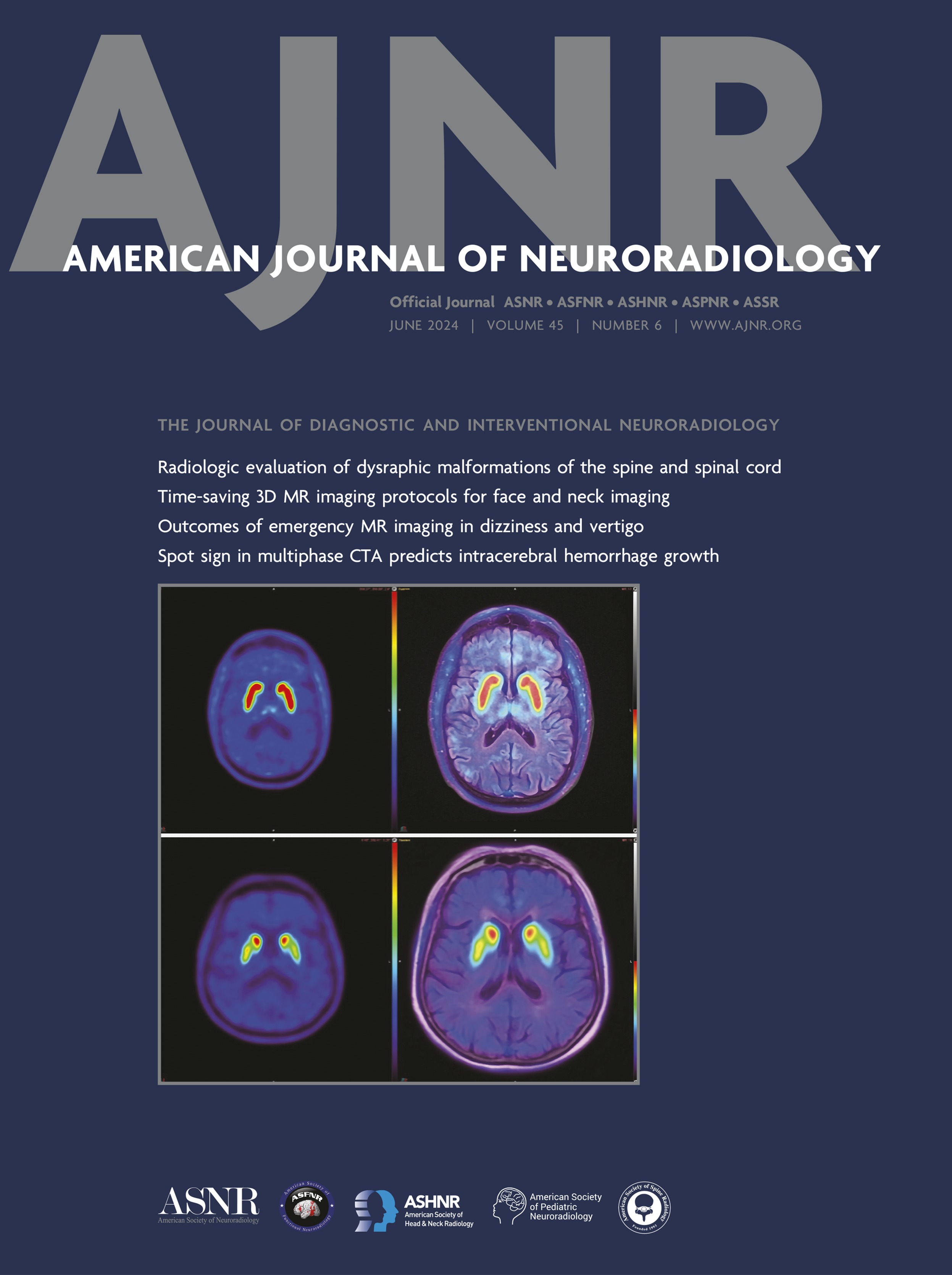 Timing of Spot Sign Appearance, Spot Sign Volume, and Leakage Rate among Phases of Multiphase CTA Predict Intracerebral Hemorrhage Growth [NEUROVASCULAR/STROKE IMAGING]