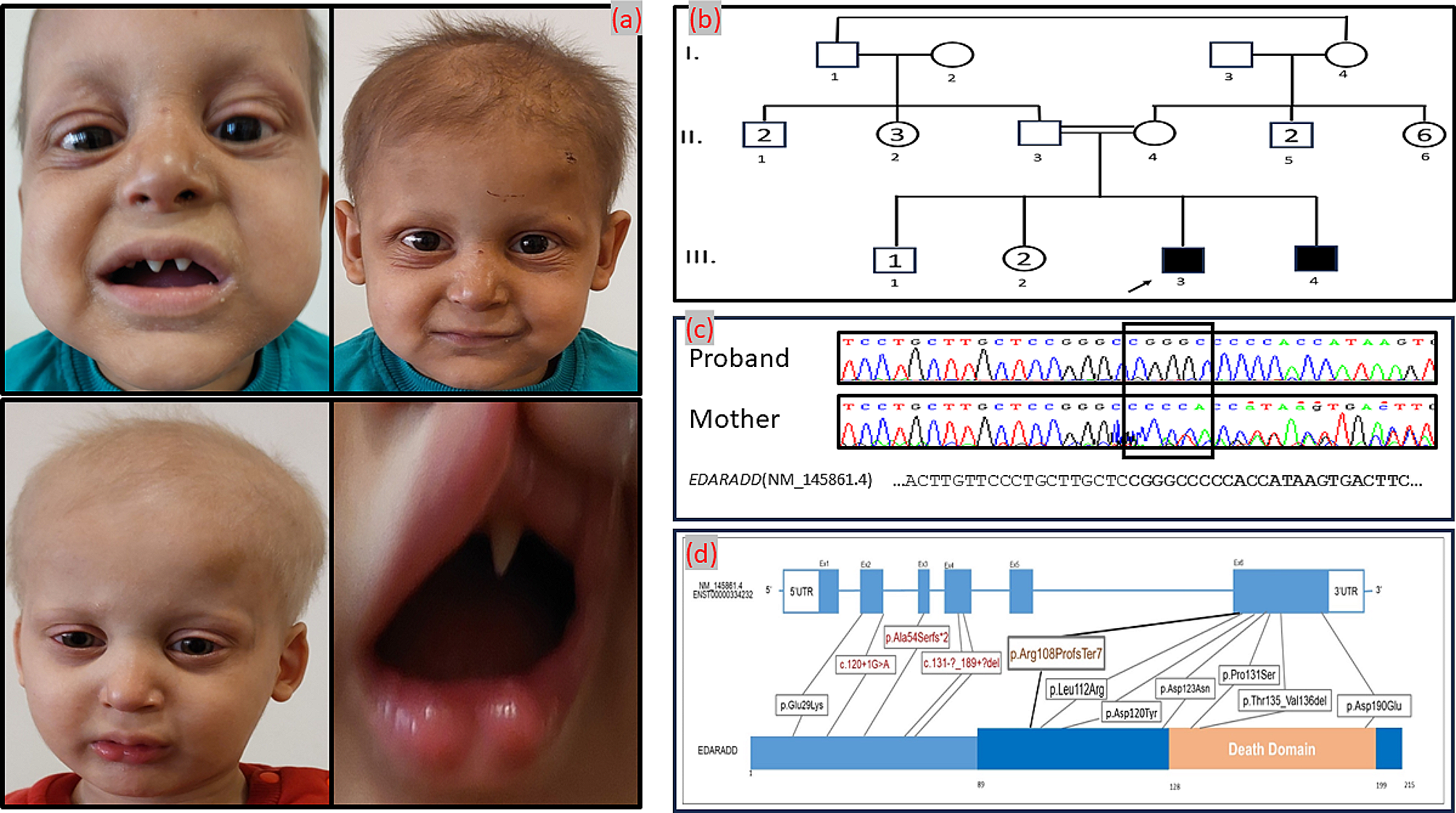 Novel homozygous frameshift insertion variant in the last exon of the EDARADD causing hypohidrotic ectodermal dysplasia in two siblings: case report and review of the literature