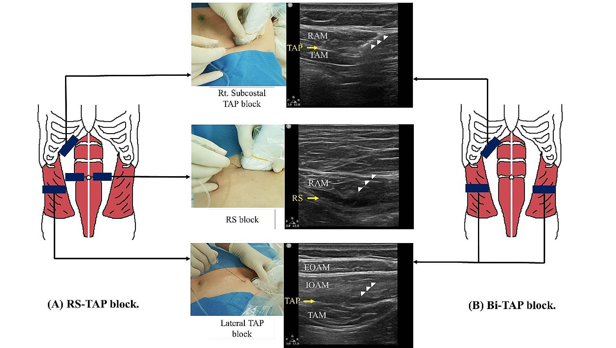 Analgesic effect of ultrasound-guided transversus abdominis plane block with or without rectus sheath block in laparoscopic cholecystectomy: a randomized, controlled trial